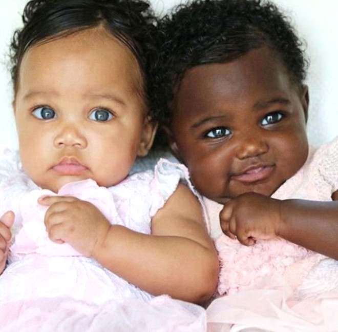 2 farklı cilt ve göz rengine sahip ikizleri gören şoke oluyor 5