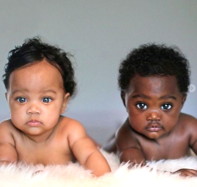 2 farklı cilt ve göz rengine sahip ikizleri gören şoke oluyor 7
