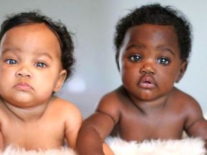 2 farklı cilt ve göz rengine sahip ikizleri gören şoke oluyor