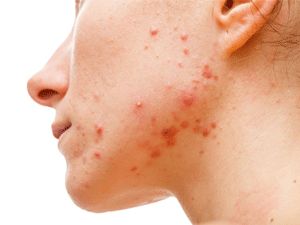 Yüzde çıkan sivilcelerin bir anlamı var!