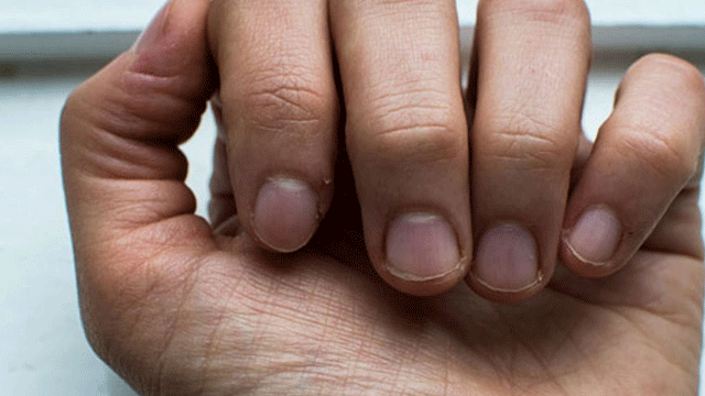 En sık görülen tırnak hastalıkları ve çözümleri