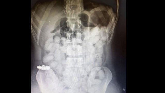 Antalya'da midesinde taşıdığı uyuşturucuyla yakalanan Brezilyalı kuryeye 25 yıl hapis