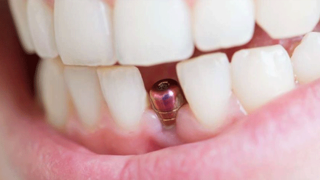 Sahte implantlar nasıl anlaşılır?