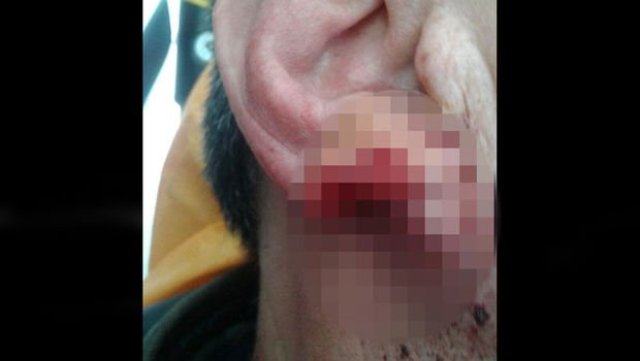 Başakşehir'de bir kişi kavga ettiği şahsın kulağını ısırarak kopardı