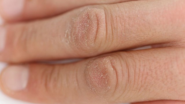 Soğuk yaralanması nedir?