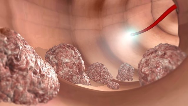 Kalın bağırsak kanserinden korunmanın 7 yolu!