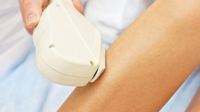 Lazer epilasyon kısırlık yapar mı?