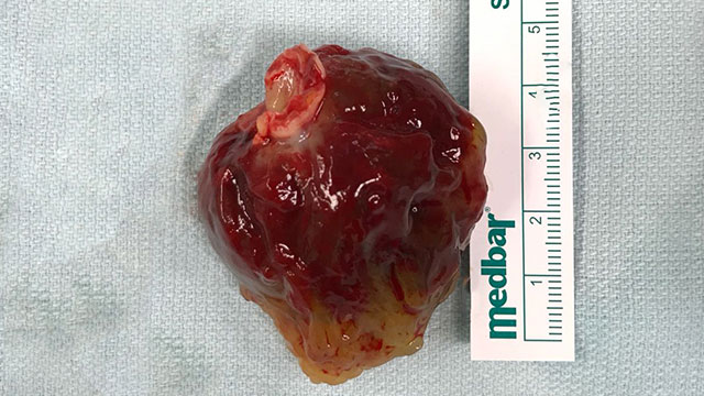 Kalbinden 5cm’lik Tümör Çıkarıldı