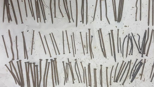 Etiyopyalı hastanın midesinden 120 adet çivi çıktı