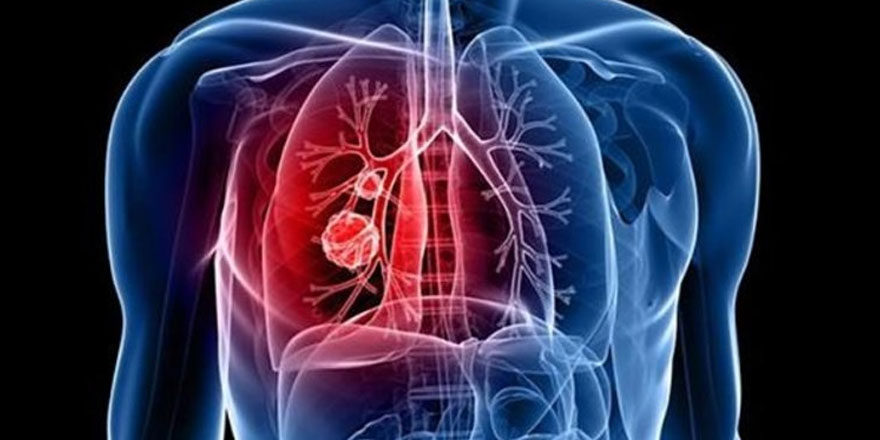 Akciğer iltihabı belirtileri nelerdir?