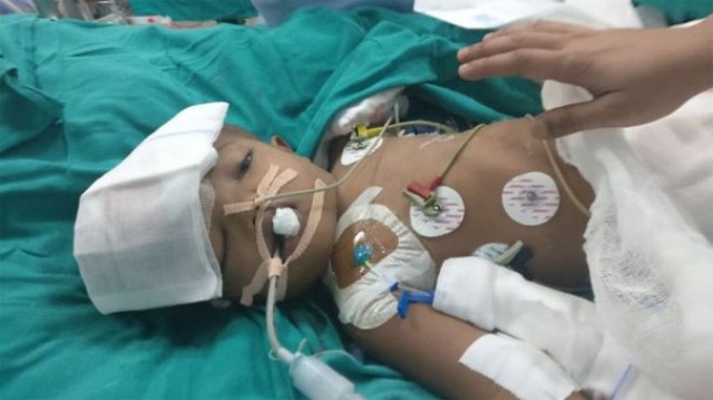 Hindistan'da yapışık ikizler ameliyatla ayrıldı