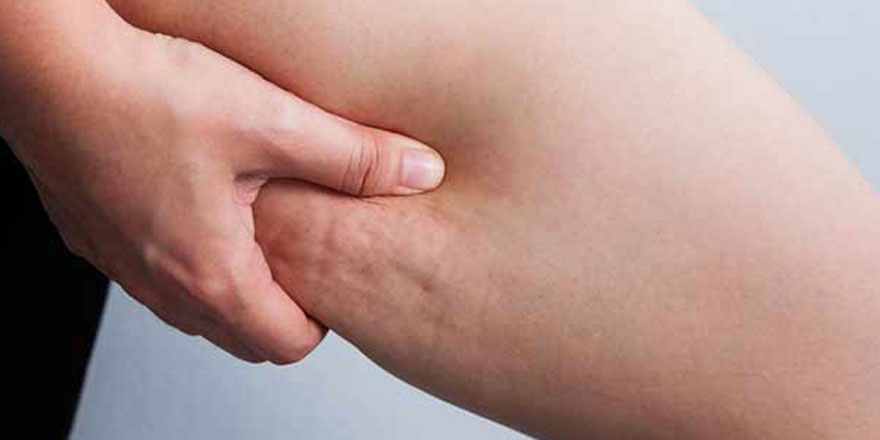 Selülit neden olur, nasıl geçer?