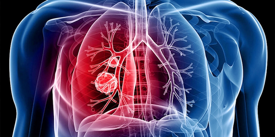 Biyologlar Derneği: “Tüberküloz öldürücü olabilir”