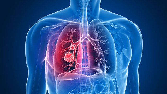 Kanser riskli akciğer nodüllerinde "mavi boya" devrimi