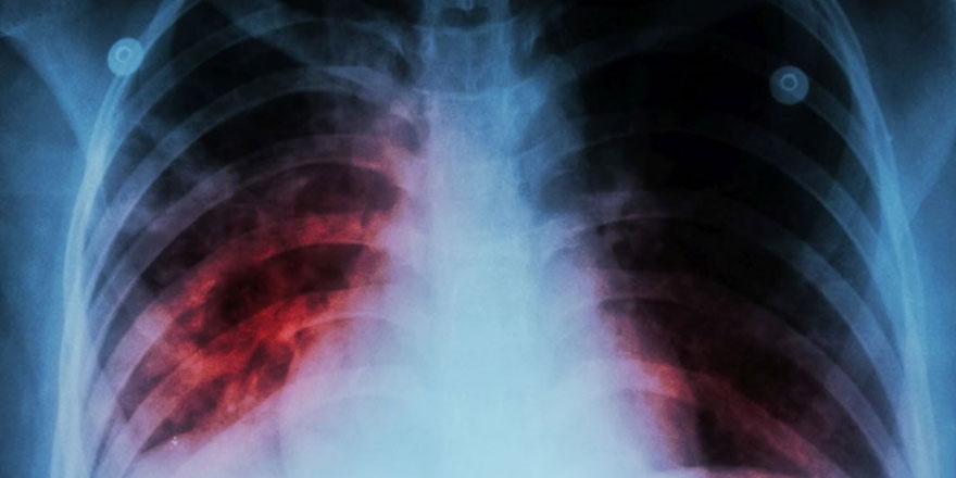 Akciğer kanserinin erken teşhisi için 6 yıl çalıştılar
