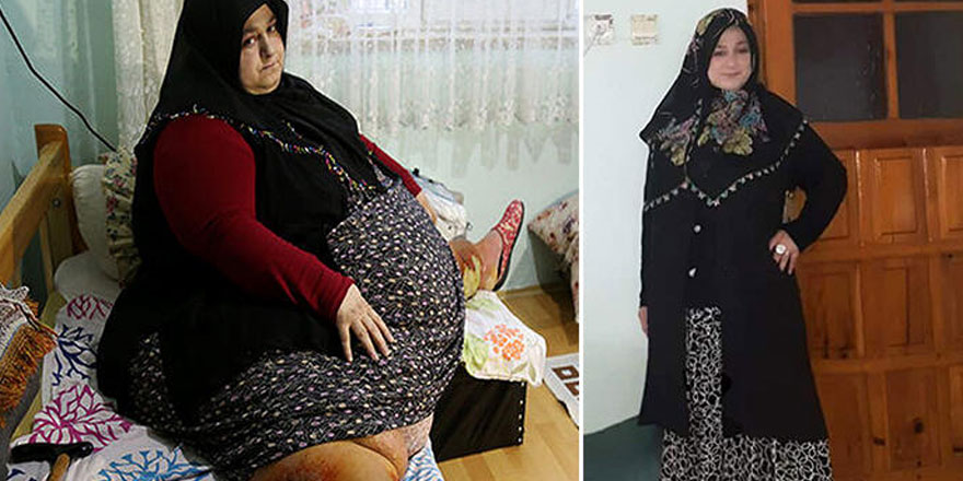 250 kiloydu... 1.5 yılda 155 kilo verdi