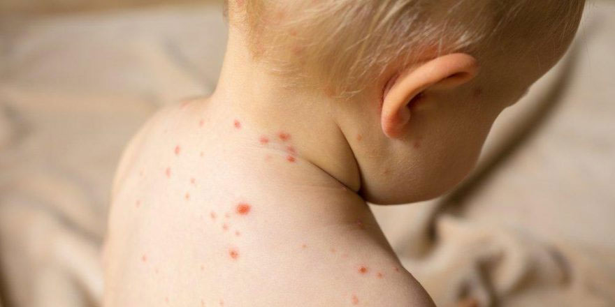 Kızamık, ‘bağışıklık bellek yitimi’ne sebep oluyor