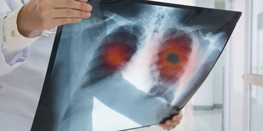 Akciğer kanserinde yeni tedavi yöntemleri sağ kalım süresini artırıyor