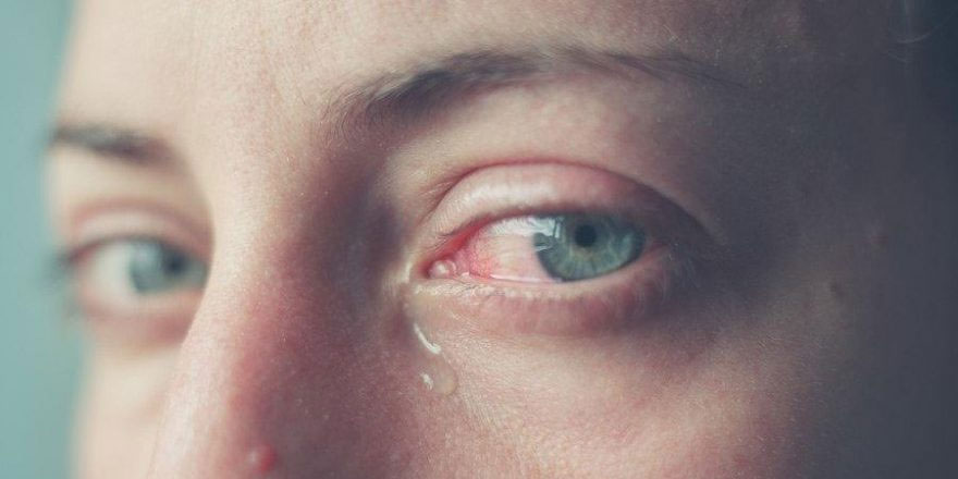 Göz sulanması neden olur?