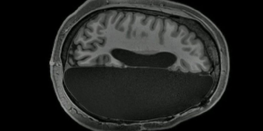 'Beyninin yarısı alınan insanlar normal yaşamını sürdürüyor'