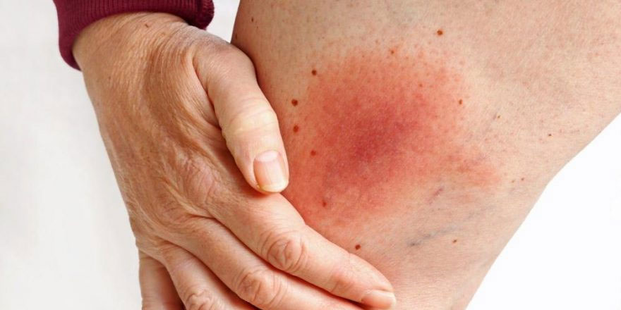 Lyme hastalığı belirtileri ve tedavisi…