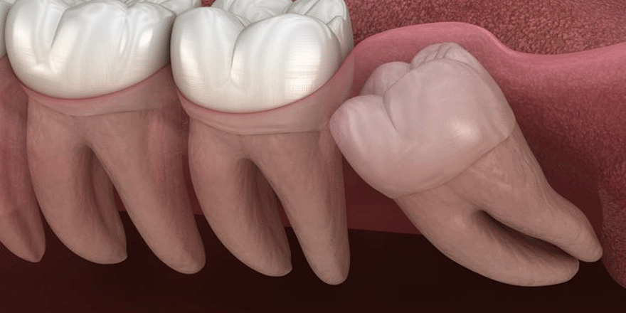 20’lik dişler gömülü kaldığında ne olur?