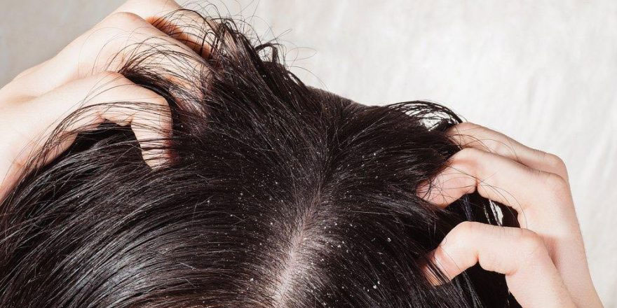 Saç kepeklenmesi nasıl geçer?
