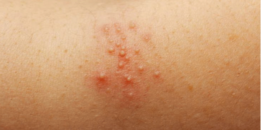 Kızamık salgını 6 bin kişinin ölümüne neden oldu