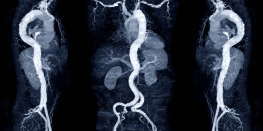 Beyinde patlamaya hazır bomba: Aort anevrizması nedir?