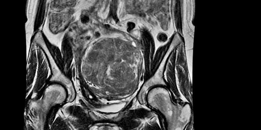 Cinsel organ çürüten ‘Et yiyen ülser hastalığı’