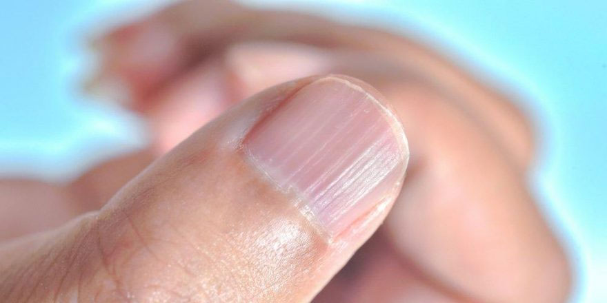 Demir eksikliği belirtileri nelerdir?