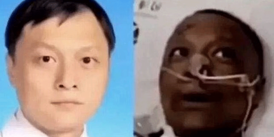 Corona nedeniyle ten rengi değişen Çinli doktor hayatını kaybetti