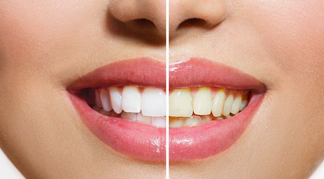 En sağlıklı diş beyazlatma yöntemi nedir?