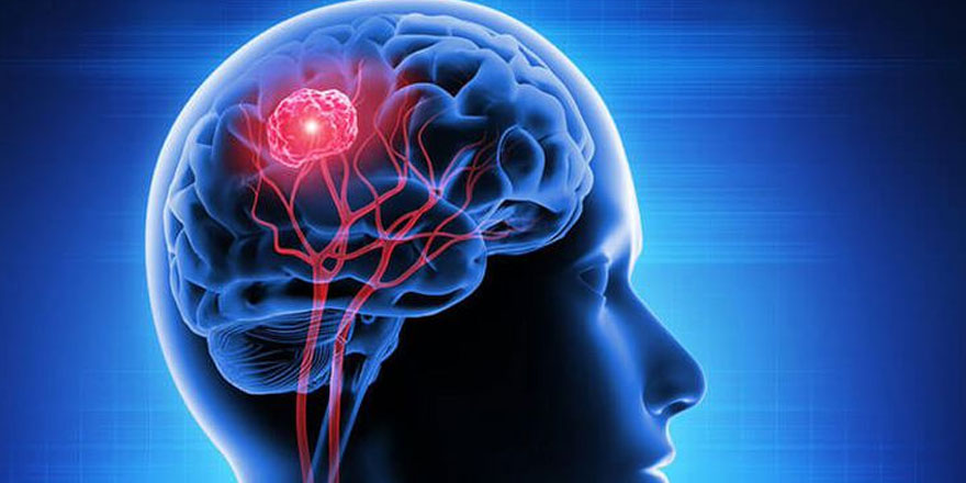 Beyin tümörünün 6 erken belirtisi!