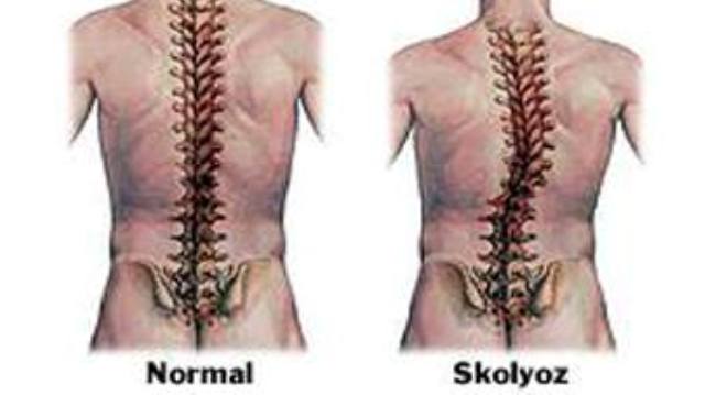 Sırtta düzleşme veya kamburluk skolyoz belirtisi