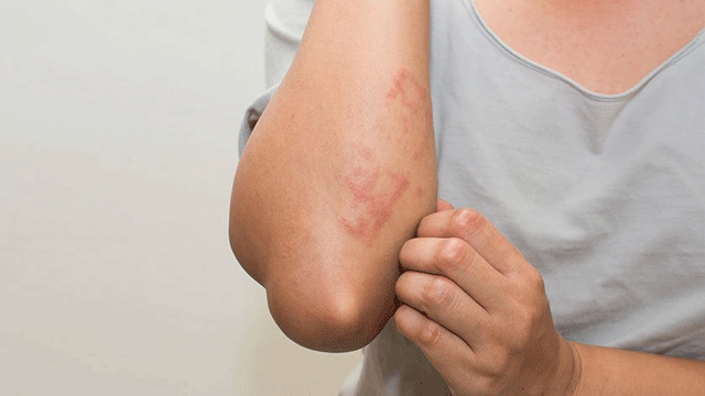 Egzaması olanlar duş jeli kullanmalı mı? Egzamanın belirtileri nelerdir?