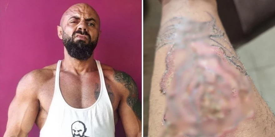 Cenk Hoca üçüncü derece yanıkla hastaneye kaldırıldı