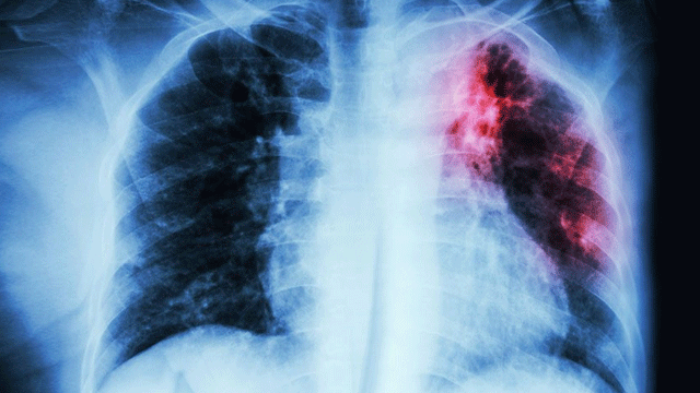 Verem hastalığının 8 belirtisine dikkat!