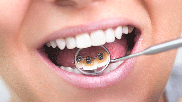 Güzel gülüşlerin sırrı koruyucu ortodonti olabilir!