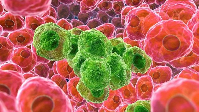 Kanserin 20 ölümcül belirtisi!