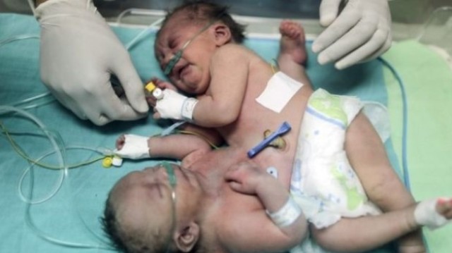 Gazzeli yapışık ikizler Suudi Arabistan'da ameliyatla ayrıldı