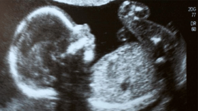 Bebeğin cinsiyeti ne zaman belli olur?