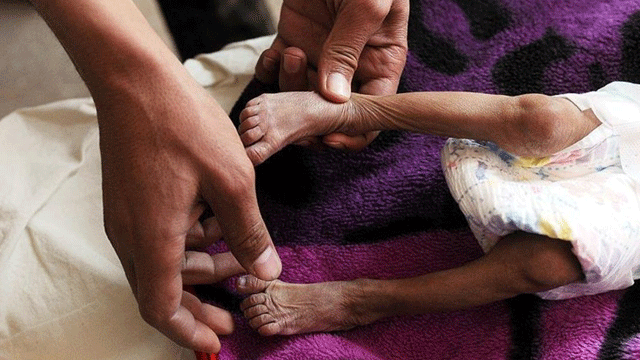 Yemen'de son iki ayda difteri nedeniyle hayatını kaybedenlerin sayısı 48'e yükseldi