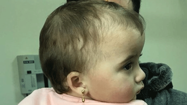 14 aylık bebeğe kafa şekillendirme ameliyatı