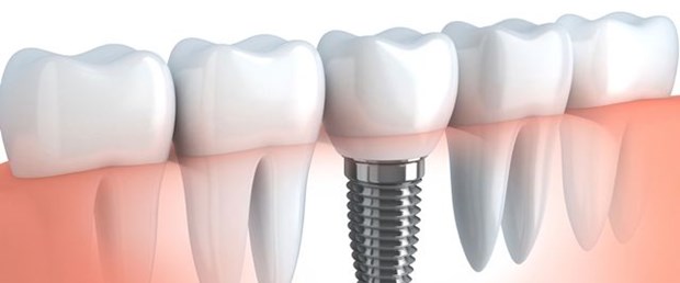 İmplant tedavisinde dijital planlama avantajı