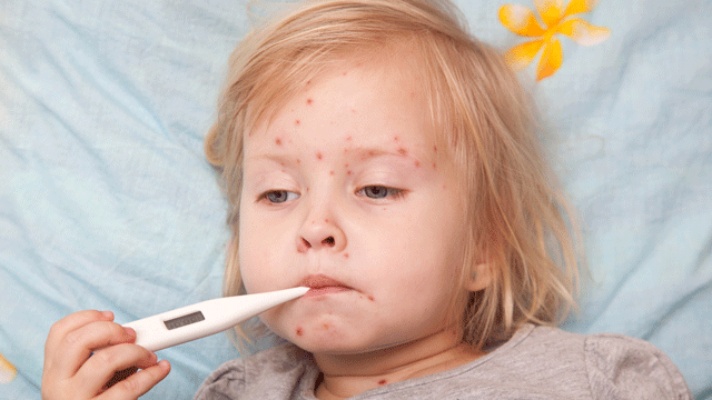 Güney Kıbrıs’ta kızamık vakaları üçe çıktı