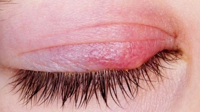 Gözde çıkan arpacığı geçirmenin en hızlı ve doğal yolu