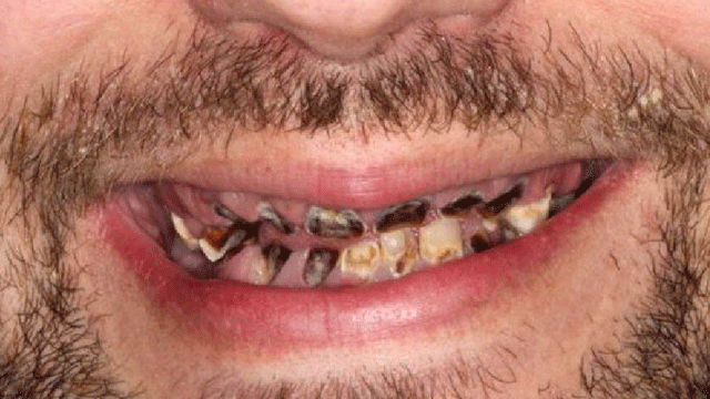 Bu bağımlılık tüm dişlerini paramparça etti!