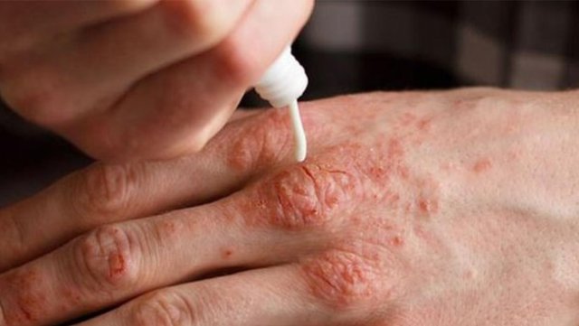 Soğuk havada bol bol su egzamadan koruyor