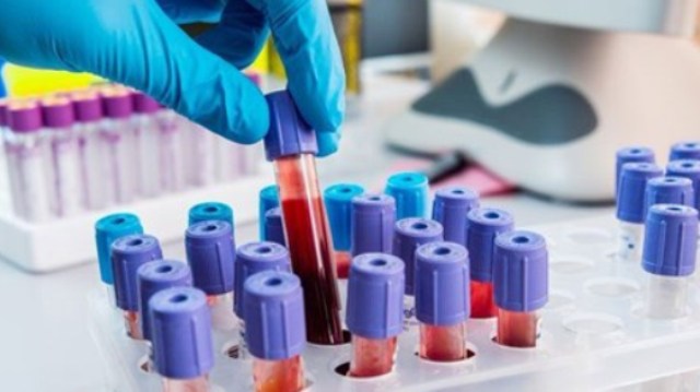 Karaciğer kanserine kanla erken teşhis